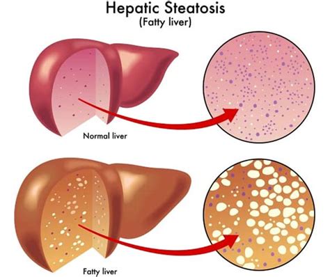 Knowing About Fatty Liver Causes Signs Symptoms