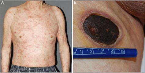 A Clinical Photographs Of Initial Angioimmunoblastic T Cell Lymphoma