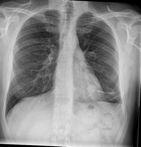 Solitary Pulmonary Nodule Radiology Reference Article