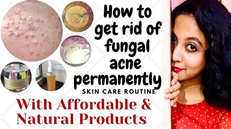 Fungal Acne Treatment With Affordable And Homemade Products How To