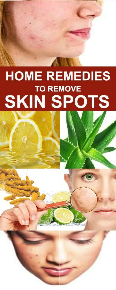 Healthbeauty Home Remedies To Remove Skin Spots