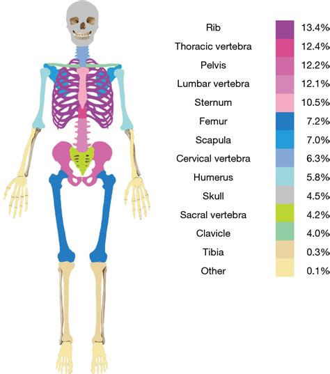 Occurrence And Distribution Of Bone Metastases In 984 Metastatic Breast