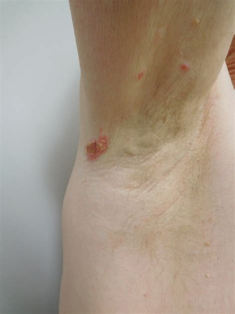 Cureus Infliximab Associated Psoriasiform Dermatitis Case Report And