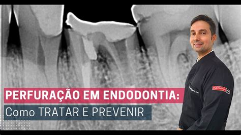 Perfuração em Endodontia Como tratar e prevenir YouTube