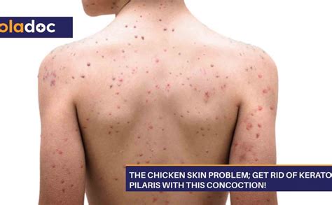 The Chicken Skin Problem Get Rid Of Keratosis Pilaris With This