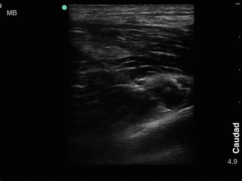 Axillary Nerve Deltoid — Highland Em Ultrasound Fueled Pain Management