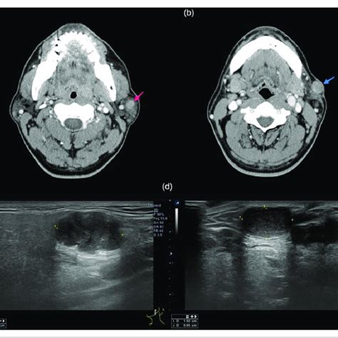 Preoperative Evaluation Of Tumors Enhanced Neck Ct A B And
