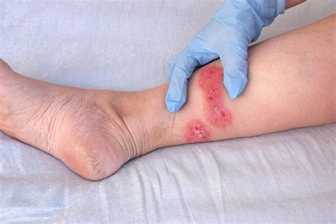 How To Heal Recurring Diabetic Sores On Legs With Amniotic Allografts