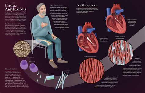 Roxanne Ziman Biomedical Illustrator Cardiac Amyloidosis