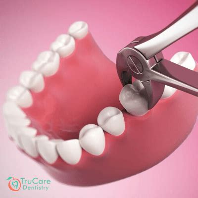 Tooth fracture during the extraction is one of the most common tooth extraction complications, especially if the tooth has a large restoration. Complications in Tooth Extraction - TruCare Dentistry Roswell