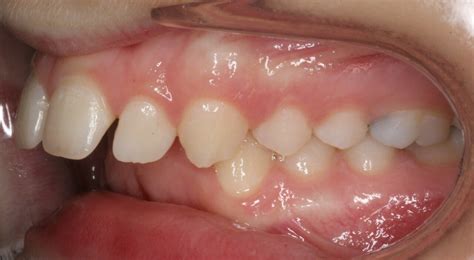 Deep Over Bite Large Overjet Braces With Jaw Surgery
