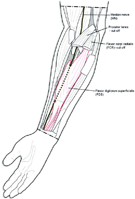 Discovered Course Of The Median Nerve Scheme Download Scientific Diagram