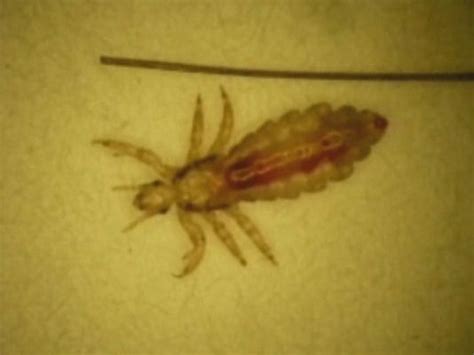Washington Lice Grow Resistant To Common Treatments