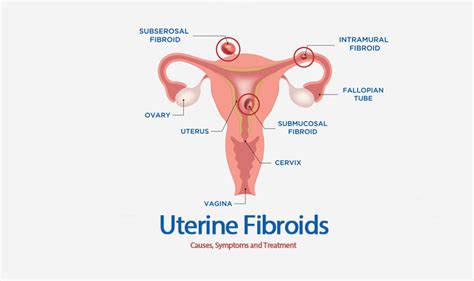 Uterine Fibroids Ayushman Hospital And Health Services