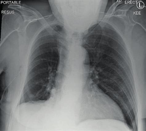 Lung Window Of Ct Scan Showing Right Pneumothorax And A Pleural