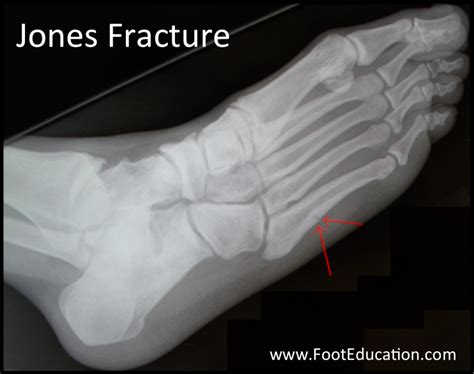 Jones Fracture Footeducation