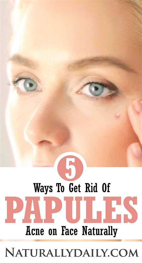 5 Ways To Get Rid Of Papules Papules Acne Home Remedies For Acne