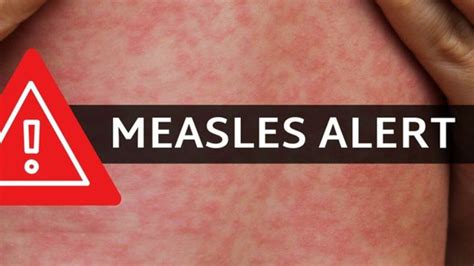 Measles Warning After Man Returns Home With Disease Queensland Times