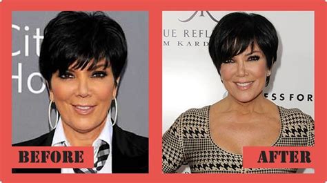 Kris Jenner Plastic Surgery Getting Fame With The Surgeries Kris Jenner Plastic Surgery
