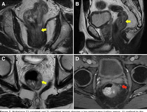 Rectal Cancer Staging Mri