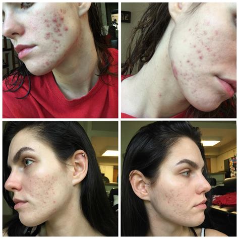 Acne Any Recommendations On How To Get Rid Of Post Inflammatory Hyper