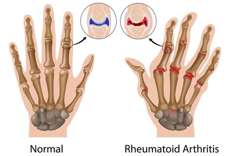Does Cracking Knuckles Cause Arthritis Natural Treatment