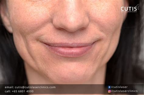 Combat Signs Of Aging In Your Lower Face Cutis Laser Clinics Singapore