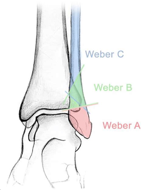 Illustration Of The Danis Weber Classification Of Lateral Malleolus