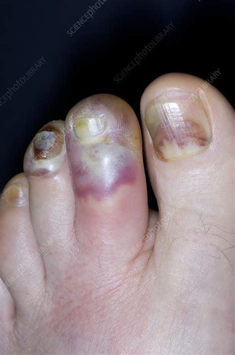 Cellulitis Of The Toes Stock Image M1300828 Science Photo Library