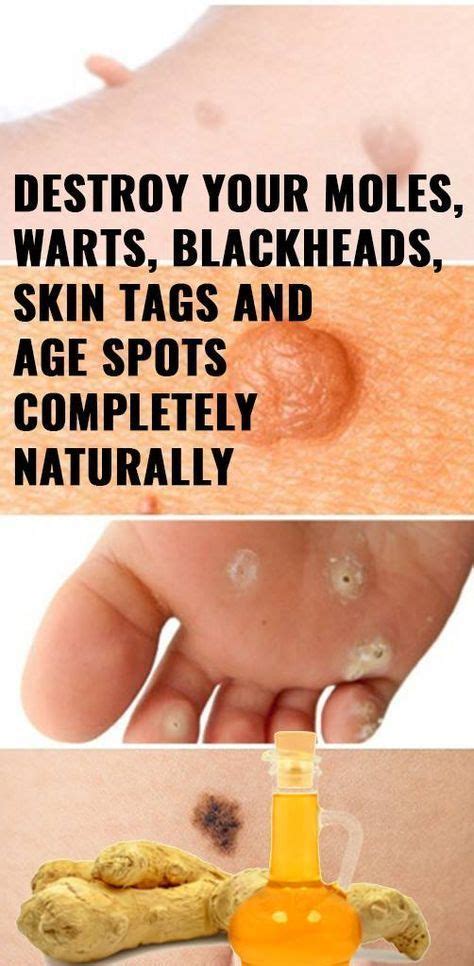 Destroy Your Moles Warts Blackheads Skin Tags And Age Spots