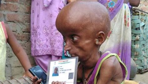 Crippled With Progeria Real Life ‘paa Awaits Aid In Allahabad Village