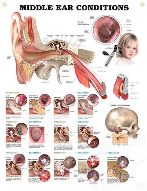 Middle Ear Conditions Chart 20x26 Middle Ear Ear Anatomy Otolaryngology