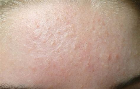 Blackheads And Scars On Forehead General Acne Discussion By
