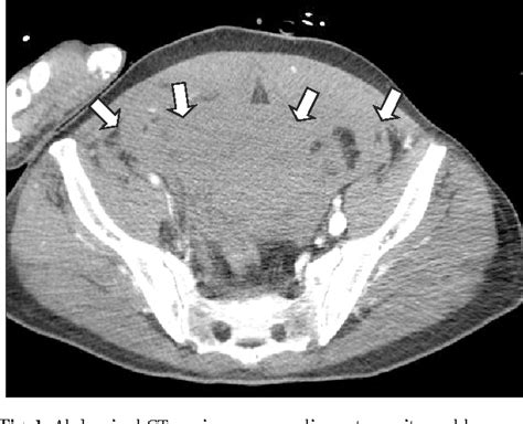 Figure 1 From Retroperitoneal Hematoma After Coil Embolization Of
