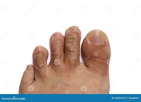 Crusty Hardened Skin On Toes Isolated On White Stock Photo Image Of