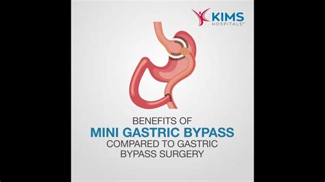 Benefits Of Mini Gastric Bypass Compared To Gastric Bypass Surgerymp4