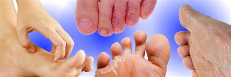 Athletes Foot Symptoms Causes And Treatment Sol Foot And Ankle Centers