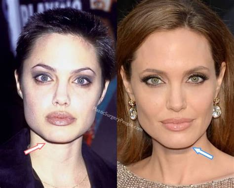 Angelina Jolie Nose Job And Cheek Implants Surgeries Plastic Surgery Hot Sex Picture