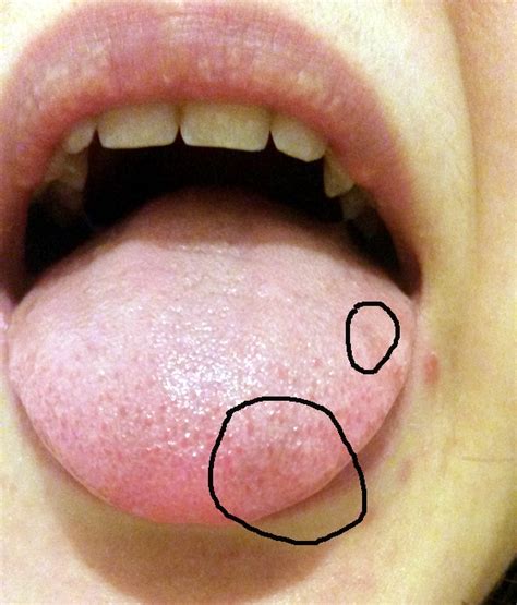 All Images Photos Of White Patches On Tongue Full Hd K K