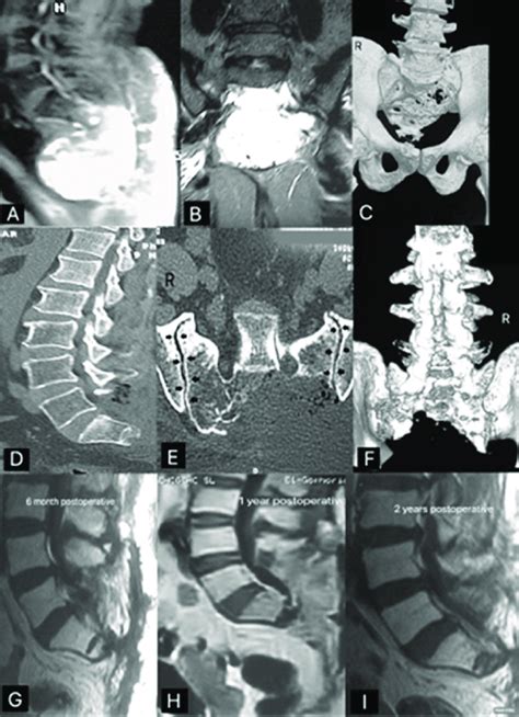 a case of s1 s2 coccyx chordoma a sagittal mri showing the download scientific diagram