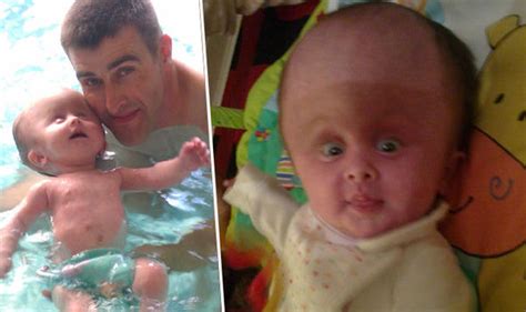 Baby With Rare Condition Born With Adult Sized Head Life Life