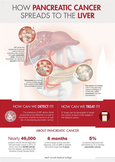 Azist Infographics Portfolio Pancreatic Cancer