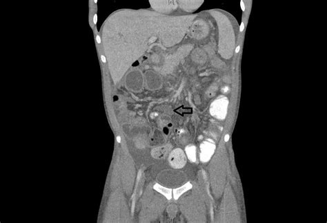 Cureus Atypical Clinical Presentation Of Crohns Disease As Diffuse