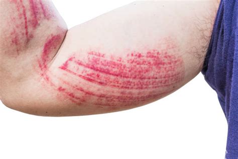 Swollen Arm Stock Photos Pictures And Royalty Free Images Istock