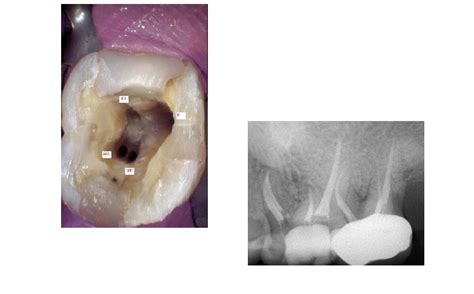 Root Canal Treatment Endodontic Treatment Of Maxillary St Molar With