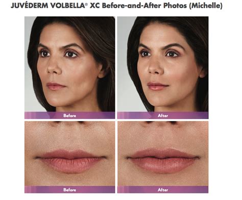 Juvederm Volbella Lip Injection Treatment In Maryland