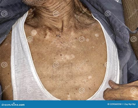 Aging Spots Called Liver Spots Nevi And White Patches On The Chest
