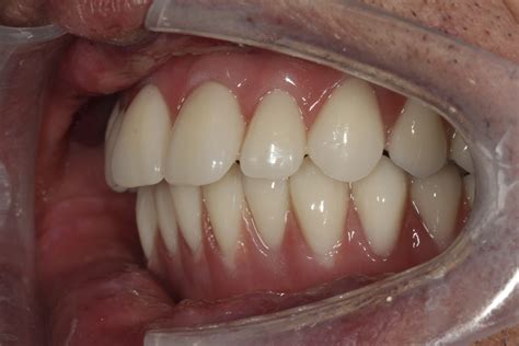Severe Overbite Treated With All On 4 Plus Dental All On 4 Clinic
