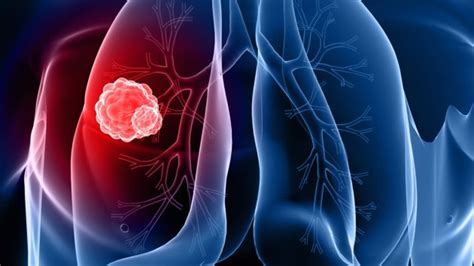As you may have a number of symptoms, you may be given a combination of treatments. 5 Symptoms and Warning Signs of Lung Cancer - Guardian ...