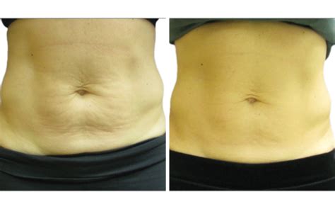 Body Skin Tightening Before And After Lightrx Medspa